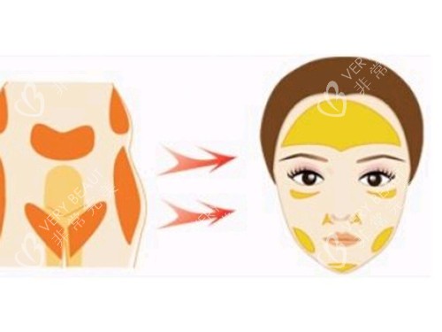 脸部脂肪填充图片