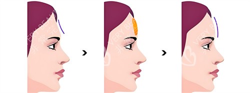 假体填充额头手术动画图