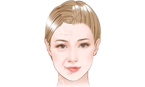 注射美容3 注射美容3