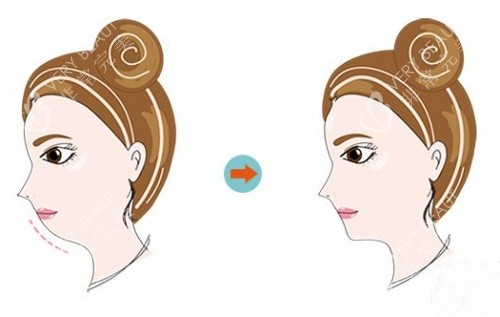 正颌前后示意图 正颌前后示意图