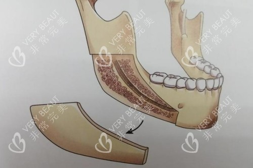 下颌角截骨卡通图 下颌角截骨卡通图