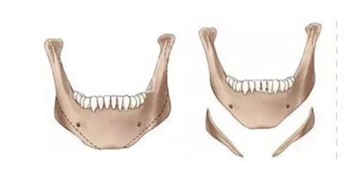 下颌角成角截骨术 下颌角成角截骨术