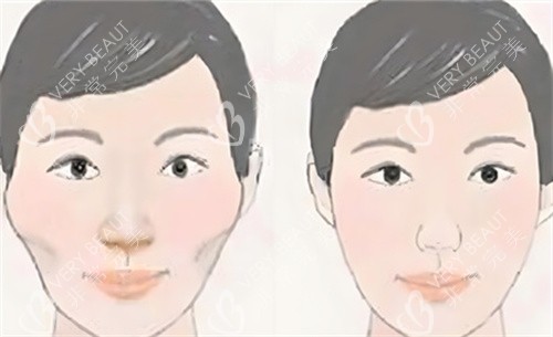 颧骨内推术前后对比动画图 颧骨内推术前后对比动画图