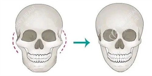 颧骨内推手术 颧骨内推手术