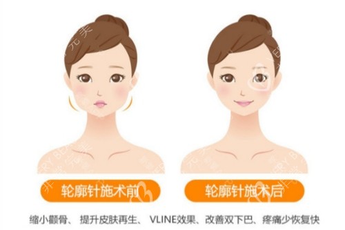 轮廓针卡通对比图