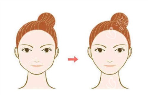 面部轮廓整形卡通图