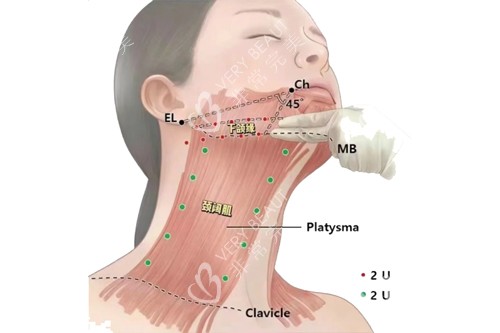 下颌缘和颈阔肌示意图 下颌缘和颈阔肌示意图