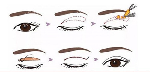 全切双眼皮过程示意图 全切双眼皮过程示意图