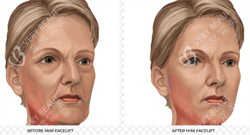 改善皮肤皱纹的面部提升 改善皮肤皱纹的面部提升