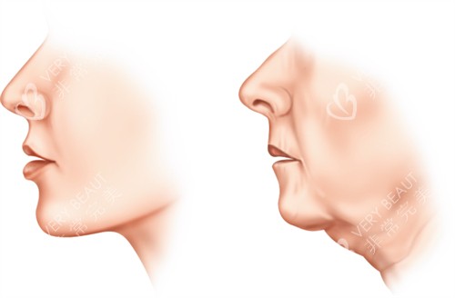面部提升前后皮肤对比 面部提升前后皮肤对比