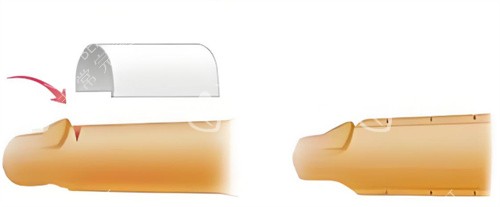 男性增粗手术示意图