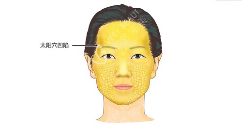 太阳穴凹陷演示动画图 太阳穴凹陷演示动画图