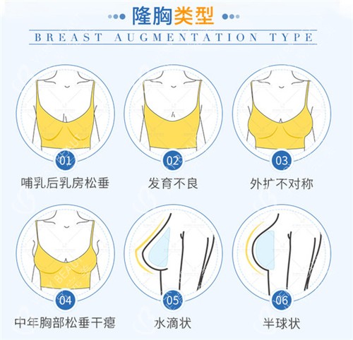 假体隆胸适应症 假体隆胸适应症