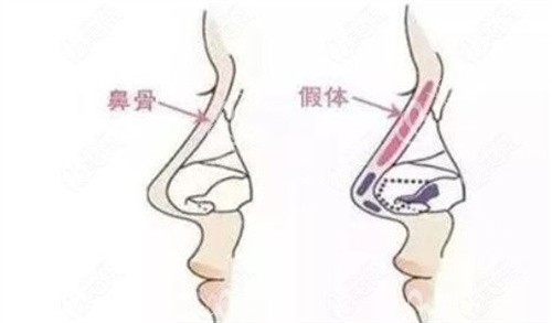 隆鼻手术示意图 隆鼻手术示意图