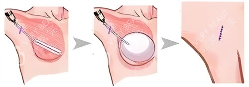 假体隆胸术图 假体隆胸术图