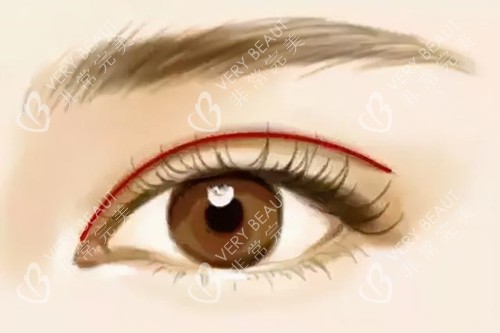 开扇形双眼皮 开扇形双眼皮