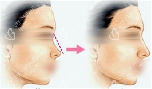 鼻背隆鼻填充前后对比图 鼻背隆鼻填充前后对比图
