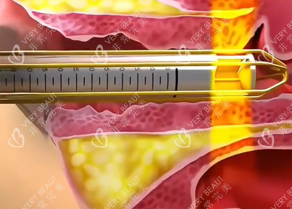 紧缩针推药示意图