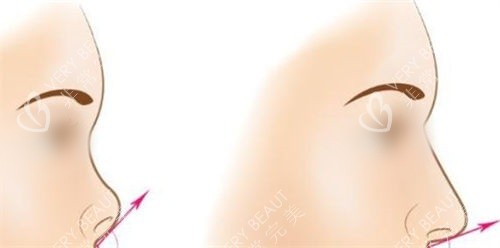 隆鼻手术鼻尖角度调整前后对比图