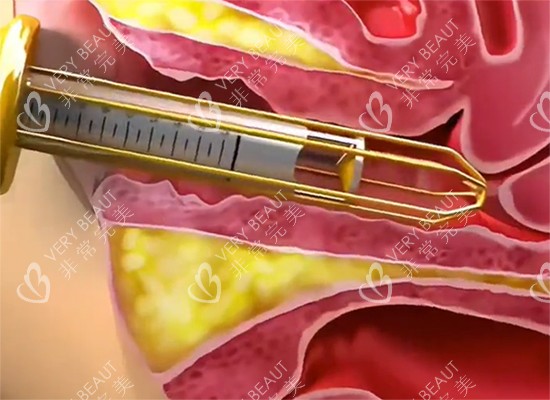 紧缩针过程示意图