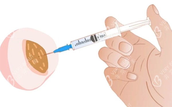 私密注射紧缩针照片