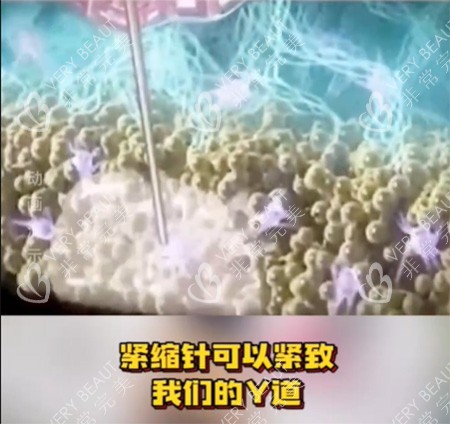 紧缩针怎么样 紧缩针怎么样