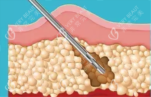 吸脂手术剖面演示图