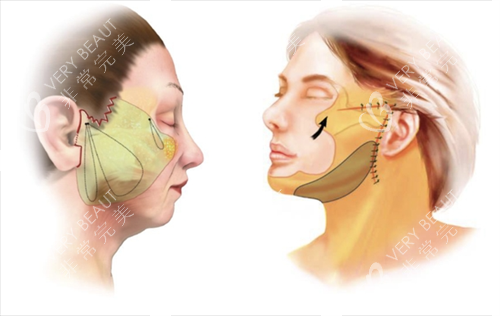 拉皮手术面部脂肪组织区域圈画图