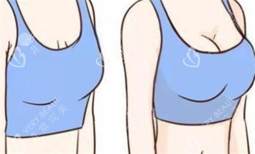 隆胸前后对比图