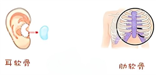 隆鼻耳软骨鼻肋骨鼻取材区别