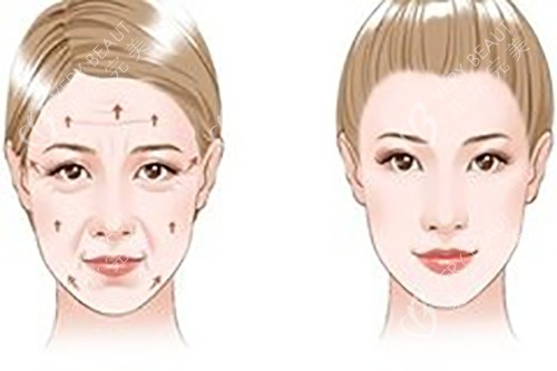 玻尿酸美容外观图 玻尿酸美容外观图