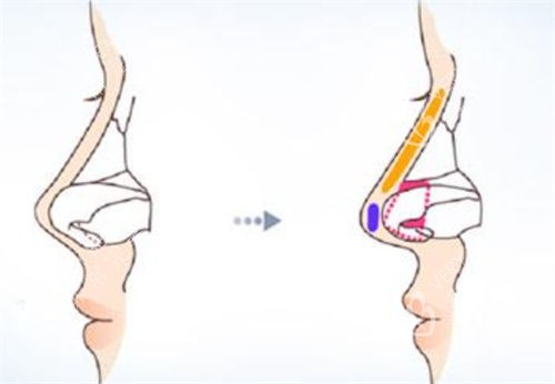 鼻尖鼻梁隆鼻手术前后对比图 鼻尖鼻梁隆鼻手术前后对比图