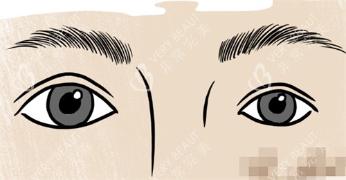 双眼皮大小眼修复 双眼皮大小眼修复