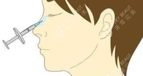 注射隆鼻侧面 注射隆鼻侧面