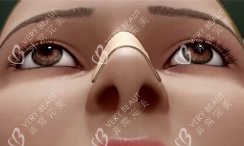 隆鼻卡通图 隆鼻卡通图