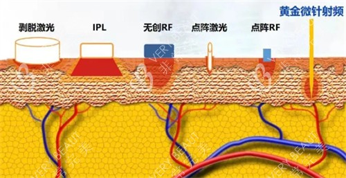黄金微针射频层次 黄金微针射频层次