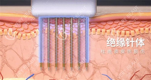 黄金微针针头图解 黄金微针针头图解