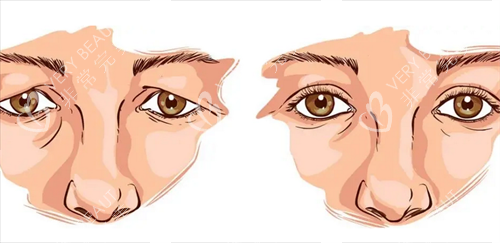 双眼皮修复前后 双眼皮修复前后