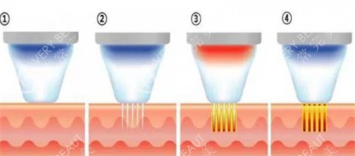 黄金微针施术步骤介绍 黄金微针施术步骤介绍
