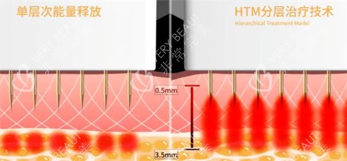 黄金微针技术介绍 黄金微针技术介绍