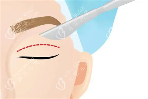 割双眼皮示意图 割双眼皮示意图