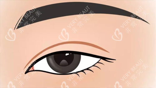 双眼皮形态展示 双眼皮形态展示