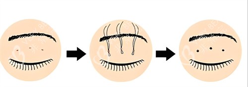 双眼皮三点术过程 双眼皮三点术过程