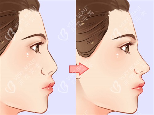 隆鼻手术前后对比展示 隆鼻手术前后对比展示