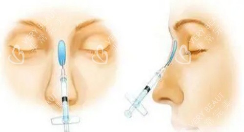 玻尿酸注射隆鼻示意图 玻尿酸注射隆鼻示意图