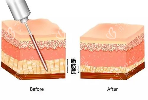 吸脂前后对比卡通示意图