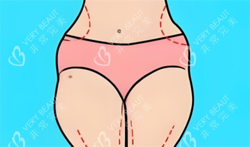 吸脂部位划线 吸脂部位划线