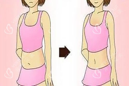 腰腹吸脂示意图卡通 腰腹吸脂示意图卡通