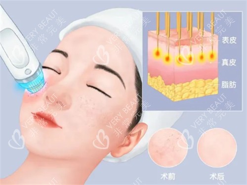 黑曜双波黄金微针治疗层次