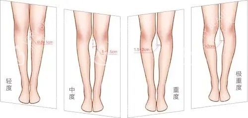 腿型矫正对比图